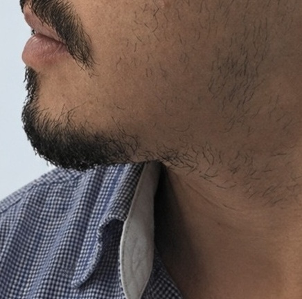 Antes: barba com pouca densidade na lateral do rosto e no pescoço, de perfil