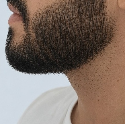 Depois: a mesma região da barba, de perfil, após o transplante de barba