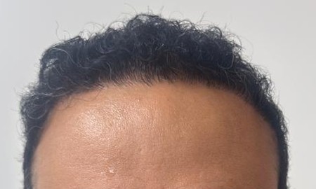 Depois: região frontal do mesmo paciente após o transplante capilar