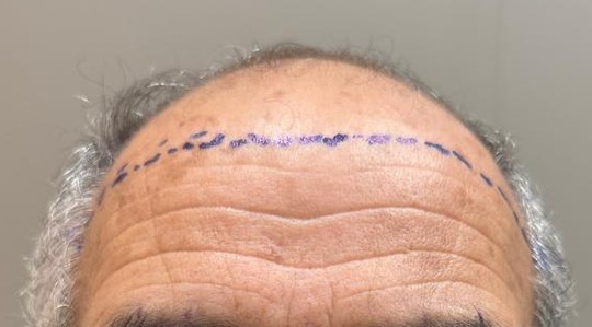 Antes: região frontal com entradas e a marcação da linha planejada